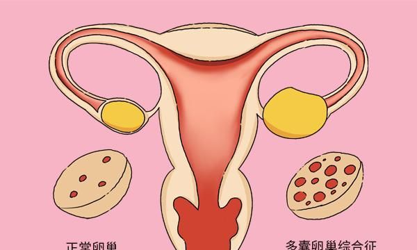 多囊卵巢患者有几种怀孕方法?只能做试管了吗?