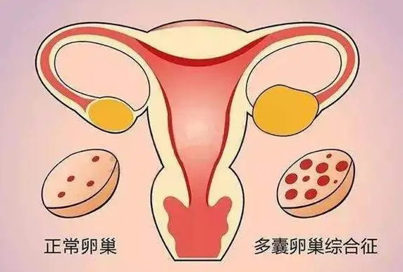 以为取卵数越多越好?小心卵巢过度刺激综合征!