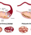 多囊卵巢女性做试管成功率很低吗?如何才能提高成功率?
