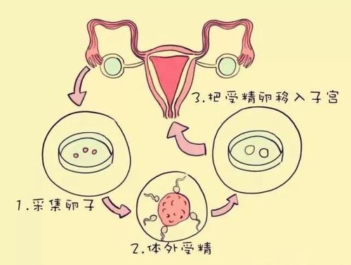 试管婴儿是什么意思 它的流程步骤有哪些？