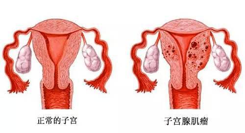 腺肌病合并不孕时有什么好办法?