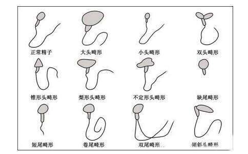 精子畸形率过高会不会导致胎儿畸形?