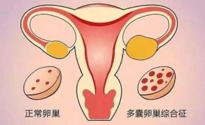 多囊卵巢综合征真的很严重吗?生孩子怎么办?